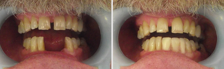 all on 4 dental implants