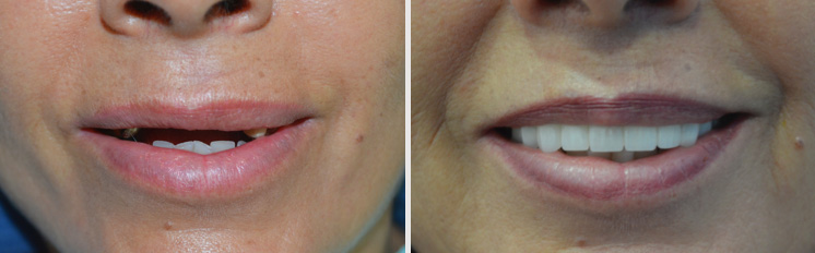 affrodable porcelain crowns