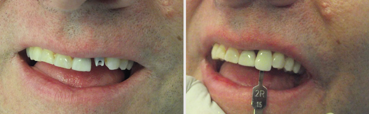 all on 4 dental implants