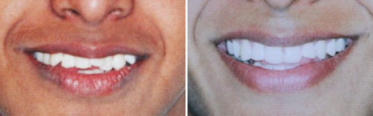 affrodable porcelain crowns