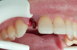 dental implant with crown