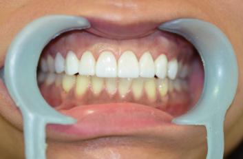 teeth veneers in mexico