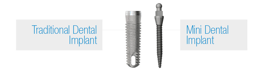 Mini Dental Implants, Dental Evolution